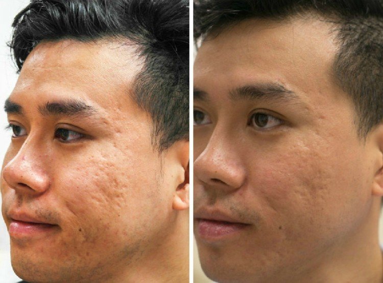 ácido de frutas peeling-faça-você-mesmo-acne-espinha-cicatrizes-antes-depois